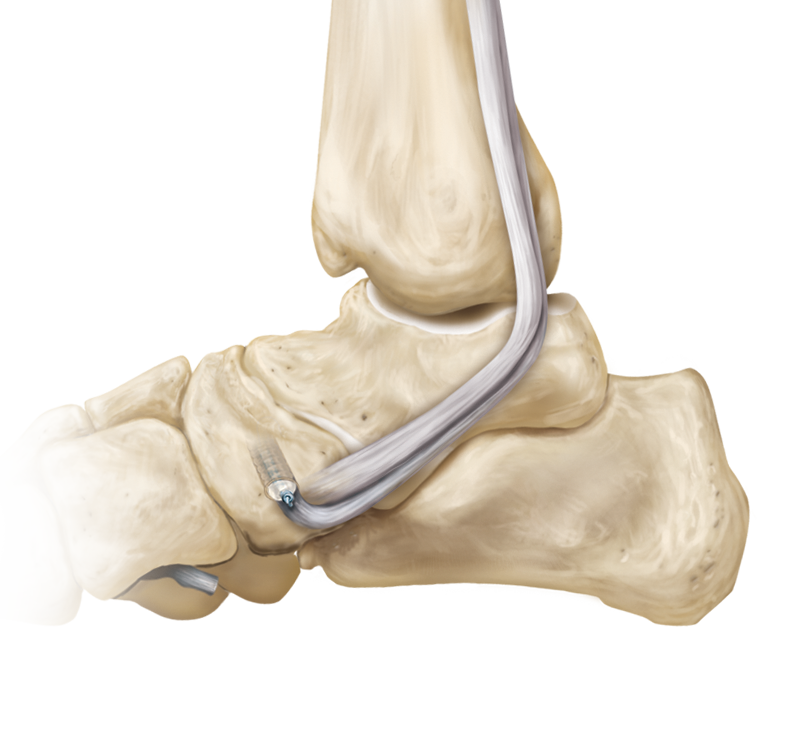 Arthrex - ProStop Arthroereisis Implant, 7 mm x 12 mm - AR Arthrex - ProStop Arthroereisis Implant, 7 mm x 12 mm - AR